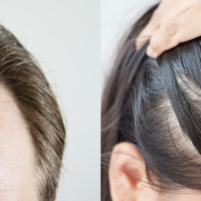 caduta capelli