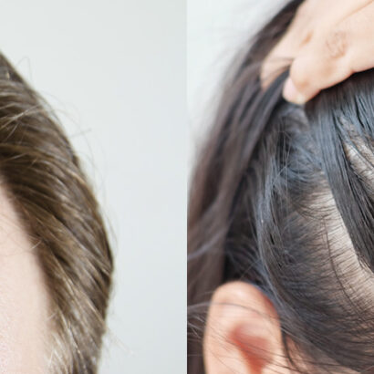 caduta capelli
